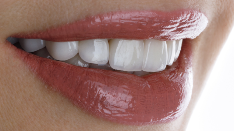 Top 5 Tips for Maintaining Porcelain Veneers
