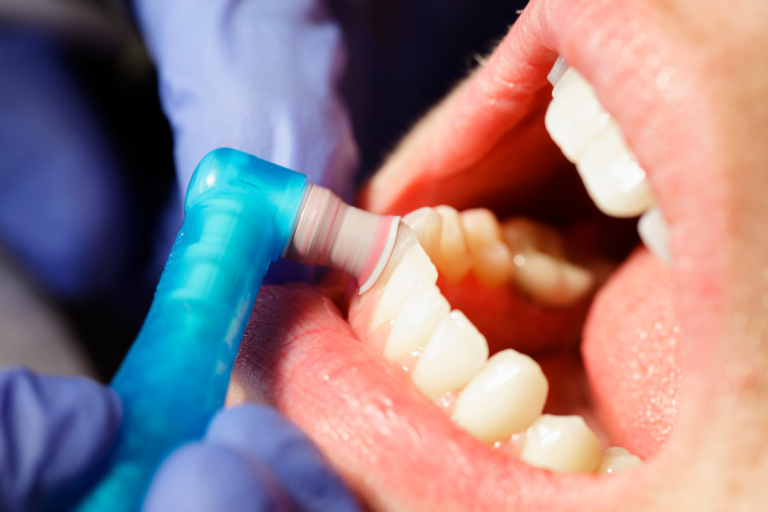 Regular vs. Deep Dental Cleaning