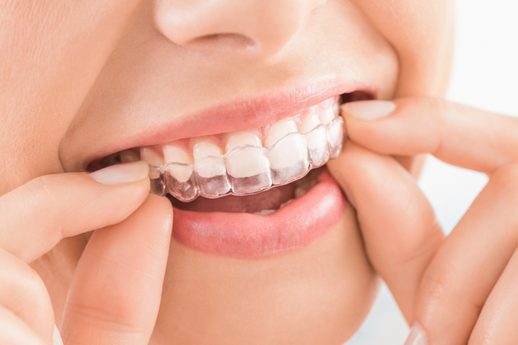 Clear dental aligners / invisalign treatment in naples, fl