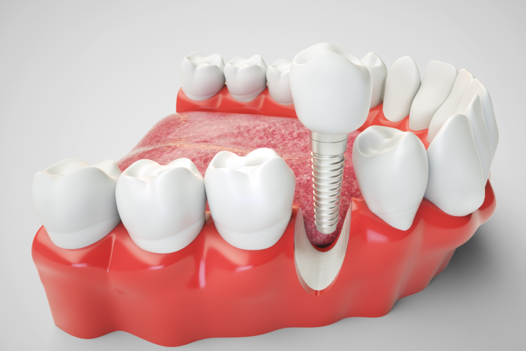 Dental implants naples dental boutique 1