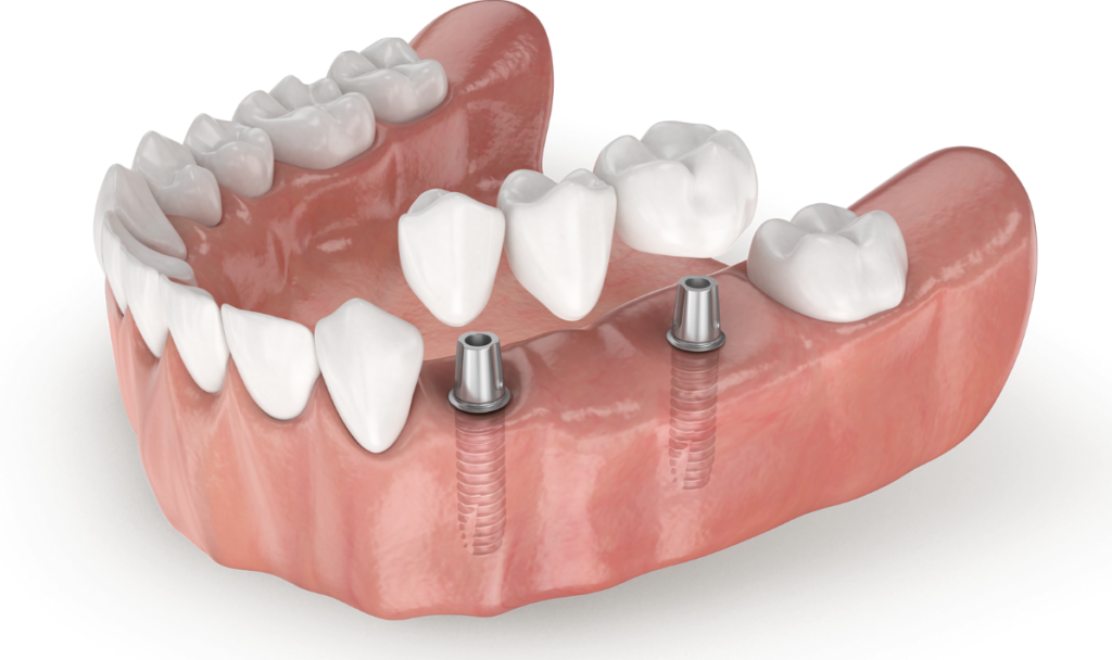 Dental implants naples dental boutique 2