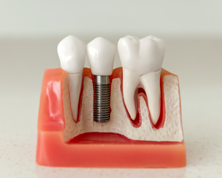 Dental Implants: Enjoy Your Every Bite