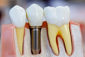 A model of teeth with dental implant