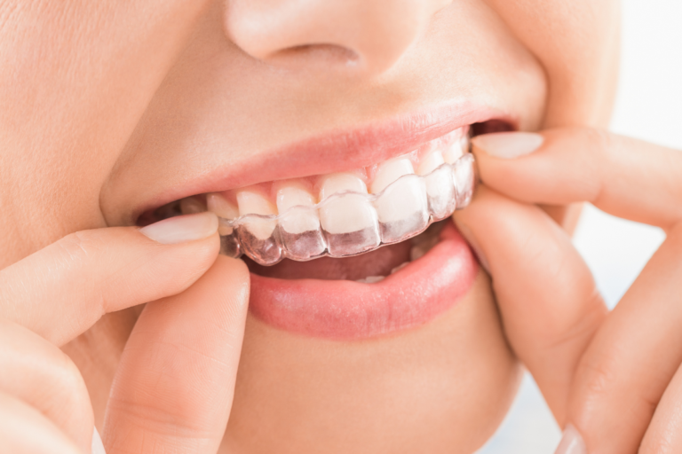 Top 10 Common Myths About Invisalign®