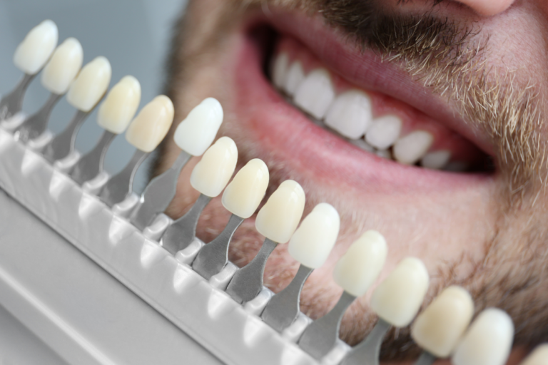 How Dental Veneers Bring Life to Your Smile