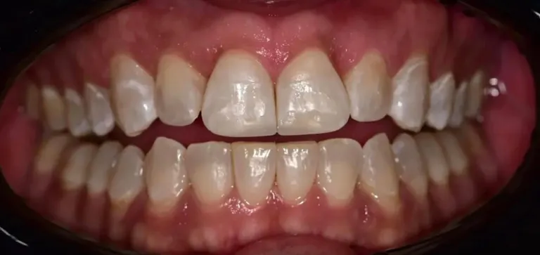 Invisalign 1