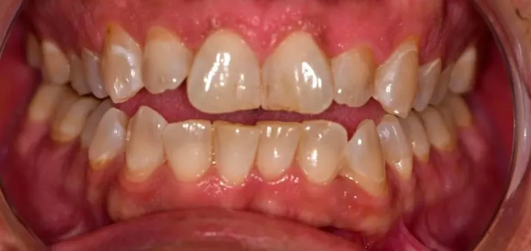 Invisalign 2