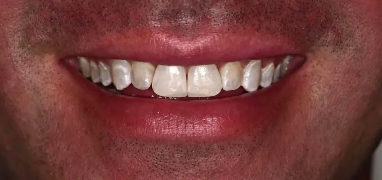 Invisalign 3