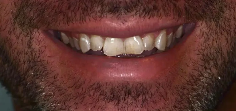 Invisalign 4