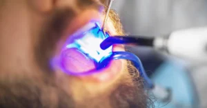 Close-up of a dental procedure using blue curing light during a composite filling or bonding treatment, highlighting advanced dental technology in use.