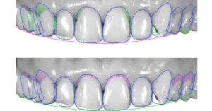 Digital smile design simulation showing upper and lower teeth with outlined measurements and alignment guides used in cosmetic dentistry treatment planning.