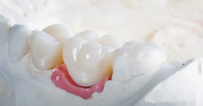Same-Day Crowns in Naples - Close-up view of a dental model featuring a set of natural-looking same-day ceramic crowns placed on molars, showcasing the fit and contour of restorative dental work.