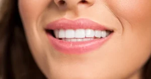Close-up of a woman’s smile showing clean, white, and evenly aligned teeth, reflecting the natural aesthetics achieved through same-day dental crown treatment.
