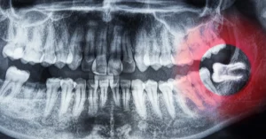 Panoramic dental x‑ray highlighting an impacted wisdom tooth in the lower right jaw, with the area marked by a red circle indicating the tooth pressing against the adjacent molar.